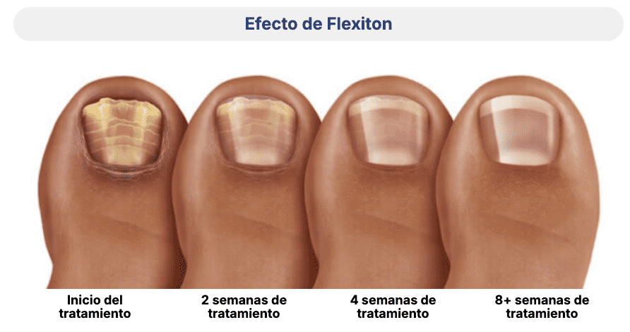 Efecto de Flexiton