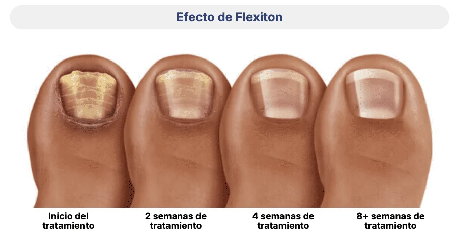 Efecto de Flexiton